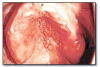 Fig 52. Inflammatory papillary hyperplasia.