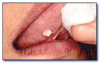 Fig 53. Papilloma.