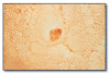 Fig 59. Granular cell tumor.