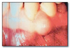 Fig 68. Gingival cyst.