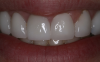 Fig 4. Veneers. Courtesy of Dentalcare.com.