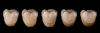 Fig 15. The same monolithic molar crown placed on five different resin-colored dies; from left to right: 1M1, 2M2, 3M2, 4M3, 5M3. Note the moderate yet significant effect on color, especially in the gingival one-third.