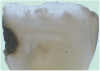 Fig 1. Ground section of a primary incisor with arrested caries lesion after SDF treatment: arrested caries that had SDF treatment. (image from Chu and Lo, 2008, ref 20 [reprinted with approval])