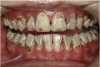 Fig 8. Use of 38% SDF to arrest rampant caries in a young teenager: pre-treatment intraoral frontal view of rampant caries. (image from Chu, et al, 2014, ref 36 [reprinted with approval])