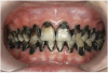 Fig 9. Use of 38% SDF to arrest rampant caries in a young teenager: frontal view of arrested caries after consecutive application of SDF for 3
weeks. (image from Chu, et al, 2014, ref 36 [reprinted with approval])