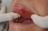 Bite Registration Seated in Mouth (Courtesy of Dux Dental)