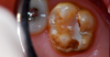 A resin-based composite had failed; the molar was sensitive, malformed, and carious.