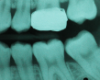 An orthodontic band was placed to distalize the second molar