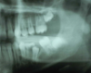 Molar migrations after loss of first molars, 8-year history: 2003