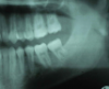 Molar migrations after loss of first molars, 8-year history: 2007