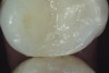 Fig 9. The remaining tooth structure supported a bonded intracoronal direct resin-based composite restoration of tooth shown in Fig 8.