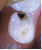 Application of silver diamine fluoride on distal of primary first molar. Silver diamine fluoride is also able to treat smaller lesion on mesial of second primary molar.