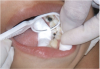 Darkened teeth after silver diamine fluoride treatment. Photos courtesy of Dr. Travis Nelson.