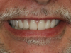Fig 10. Full smile after conversion.