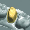 Fig 2. The die interface stage. Based on the margin set by the designer, the software calculates the shape that the inside of the crown needs in order to fit the prepped tooth.
