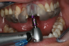 Fig 18. Final implant drill to depth.
