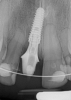 Fig 25. Postoperative periapical radiograph at 2 weeks.