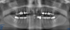 Fig 29. Preoperative Panorex.