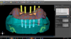 Fig 34. Implant placement proposal.