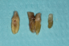 Fig 38. Periodontal casualties.