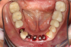 Fig 42. Occlusal view of prepared implants.
