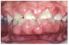 Fig 9. Calcium-blocking Agent-induced Gingival Overgrowth.