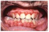 Fig 10. Cyclosporine-induced Gingival Overgrowth.