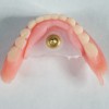 (4.) Gothic arch tracer assembly attached to the maxillary and mandibular dentures in preparation for fabrication of occlusal device.