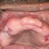 (10.) Prominent exostosis and deep undercuts may need to be reduced surgically.