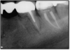 Fig 6. Successful root canal.