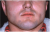 Figure 6. Acute urticaria following the oral administration of penicillin.