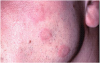 Figure 7. Acute urticaria following the oral administration of penicillin.