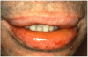 Figure 8. Acute angioedema of the lips and oropharynx following the oral administration of penicillin.