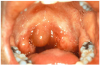 Figure 9. Acute angioedema of the lips and oropharynx following the oral administration of penicillin.