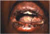 Figure 11. Characteristic iris or target lesions of the skin and serohemorrhagic crusting of the lips associated with erythema multiforme following the administration of ibuprofen.