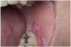 Figure 12. Lichenoid stomatitis in a patient with rheumatoid arthritis taking ibuprofen.