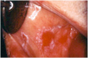 Figure 13. Lichenoid stomatitis in a patient with rheumatoid arthritis taking ibuprofen.