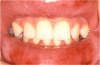 Figure 16. Type IV or Delayed Hypersensitivity Reaction in Response to a Cinnamon-flavored Sugar-free Gum.