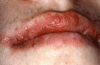 Figure 17. Type IV or Delayed Hypersensitivity Reaction in Response to an OTC Lip Balm Containing Benzocaine.