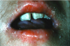 Figure 19. Severe oral, dermal, and nail infection with candidal organisms in a patient undergoing immunotherapy prior to bone marrow transplantation.