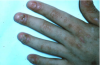 Figure 20. Severe oral, dermal, and nail infection with candidal organisms in a patient undergoing immunotherapy prior to bone marrow transplantation.