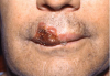 Figure 21. Atypical Herpes Labialis Secondary to the Reactivation of the Latent HSV in a Patient with Leukemia Undergoing Chemotherapy.
