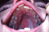 Figure 23. Herpes zoster infection involving the maxillary and ophthalmic divisions of the trigeminal nerve secondary to the reactivation of the latent VZV in a patient with leukemia undergoing chemotherapy.