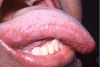 Figure 24. Hairy Leukoplakia Secondary to the Reactivation of the Latent EBV in a Patient on Therapeutic Immunosuppression Following Renal Transplantation.