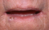 Figure 25. Squamous Cell Carcinoma of the Lip in a Patient 2 Years After Renal Transplantation.