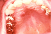 Figure 26. Human Herpesvirus-8-related Kaposi Sarcoma of the Palate in a Patient 4 Years After Renal Transplantation.