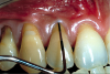 Fig 4. Patient presented with no gingiva on tooth No. 6 and 1.5 mm of gingiva on tooth No. 7 with increasing gingival recession. Probing of each tooth to 3 mm indicated a lack of attached gingiva.