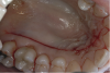 Fig 7. Harvesting a CTG requires displacement of a flap consisting of both the epithelial layer and some connective tissue. A single straight-line incision at least 3 mm away from the palatal FGM is made to gain access for harvesting the CTG.