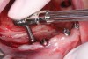 Fig 5. A spherical 4-mm fixed LOCATOR F-Tx abutment was placed into the implant at No. 13.