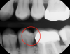 Fig 1. Pretreatment photograph, tooth No. 20.